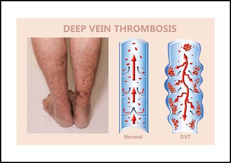 Understanding Phlebitis Causes Symptoms And Complications