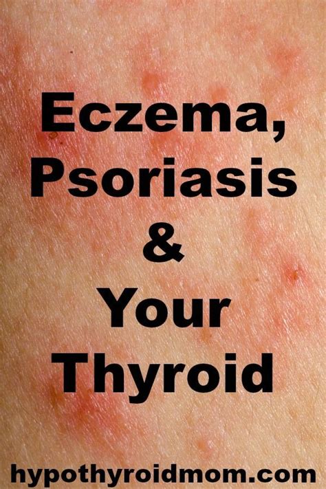 Eczema Psoriasis Your Thyroid Is There A Connection Artofit