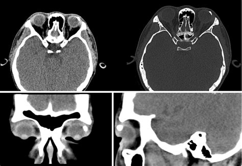 Epibulbar Osseous Choristoma Two Case Reports