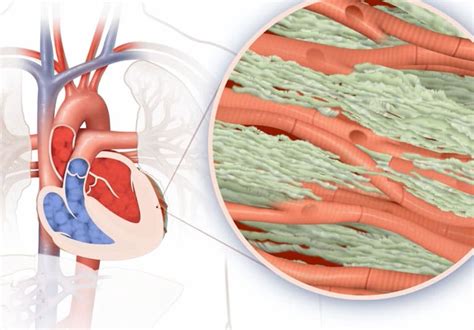 Amyloidosis The Heart Transplant Precursor To Keep On Your Diagnostic