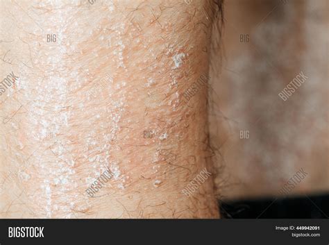 Acute Psoriasis Na Image And Photo Free Trial Bigstock