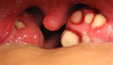 Tonsil Craters