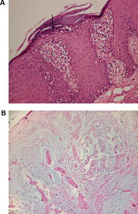 Pathological Section Showing Hyperkeratosis With Parakeratosis And