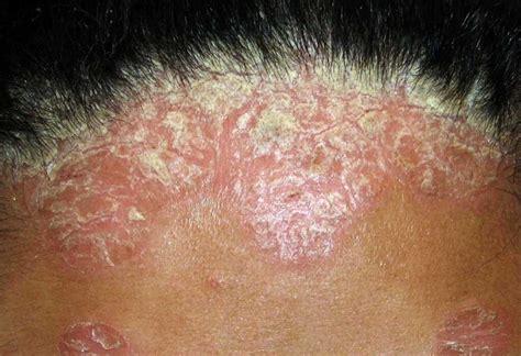 Sores On Scalp Causes With Hair Loss And Treatments American Celiac