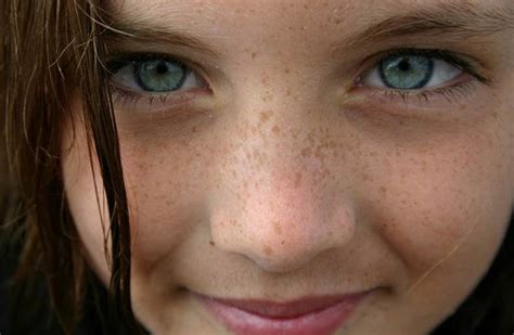Whatever remedies you are taking, it is better to. Home Remedies to Get Rid Of Freckles : Human N Health