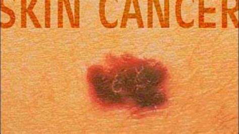Detecting Skin Cancer Cbs News