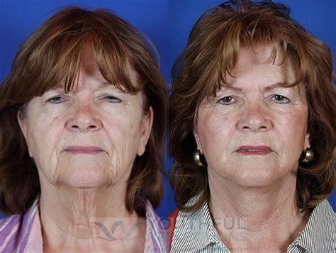 facelift reflection lift before and after photos patient 20 nashville tn youthful reflections
