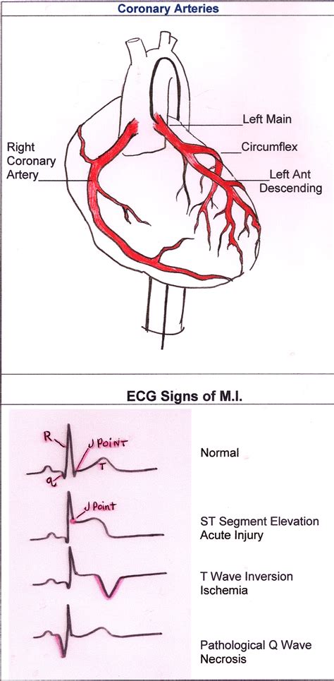 The two main branches are the left coronary artery (lca) and right coronary artery (rca). Coronary Arteries and ECG Signs of M.I. | ECG Guru ...