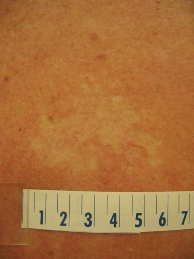 An Irregular White Patch On The Back Clinical Advisor