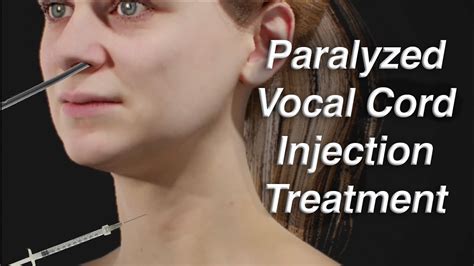 Vocal Cord Paralysis Treatment Via Needle Injection Injection