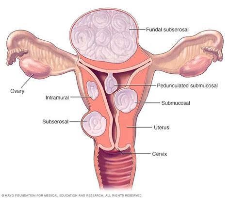 a comprehensive guide to uterine fibroids in singapore