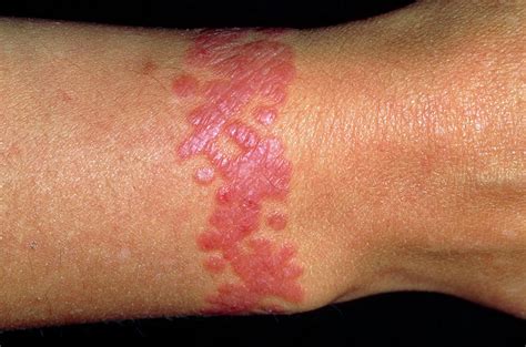 Rash Around The Wrist Of A Woman At A Tattoo Site Photograph By Dr P