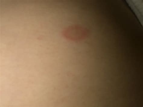 Red Circle Patch On My Skin Help Babycenter