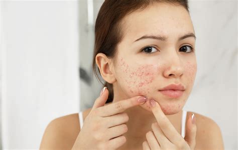 How To Fade Acne Scars Naturally
