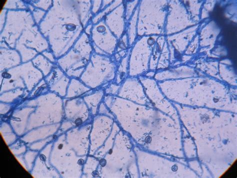 Reproductive strategies and spore formation 1. Cureus | Chronic Pulmonary Histoplasmosis and its Clinical ...