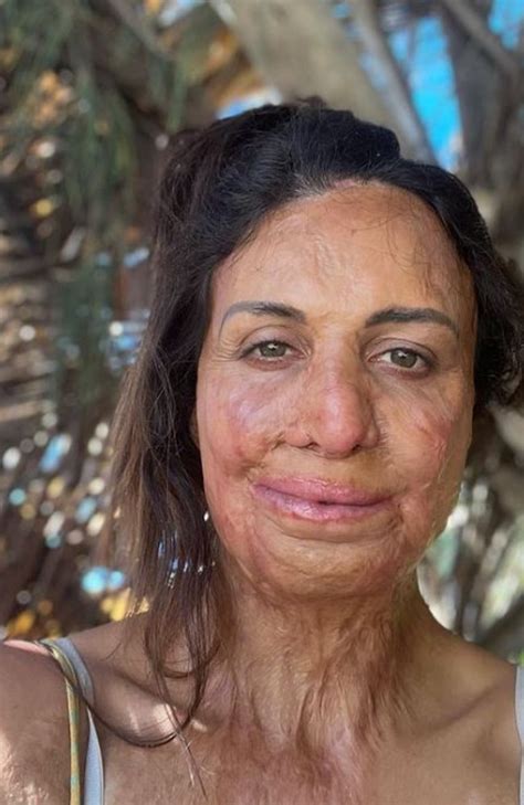 Turia Pitt Found Photos Of Herself Two Days After Her Accident Au — Australia’s