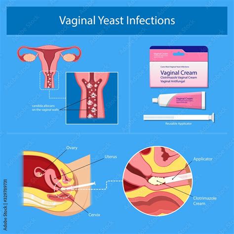 Vaginal Yeast Infections Treatment Applicator Symptoms Natural Remedies