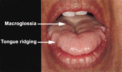 A View Of The Tongue During A Maximal Mouth Opening Tongue Extrusion Download Scientific