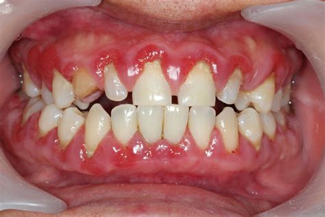 Gum Disease Glebe House Dental Care Dentist