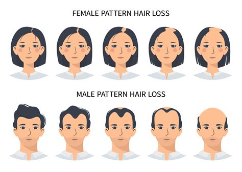 Female Pattern Baldness Receding Hairline
