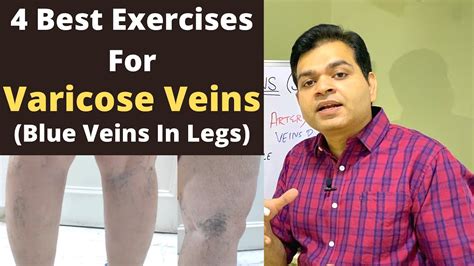 Varicose Veins Exercise Blue Veins In Legs Spider Veins Exercise