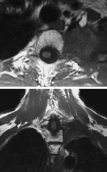Posterior Approach To The Cervicothoracic Junction Pancoast Tumor