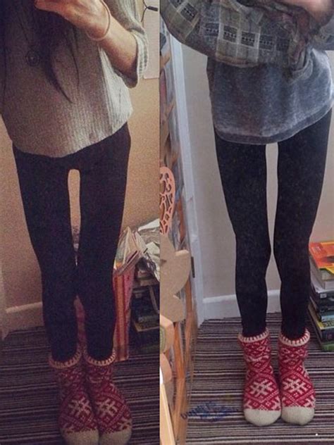 Woman Obsessed With Thigh Gap Developed Anorexia After She Exercised Three Times A Day To Lose