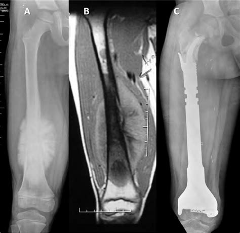 A Preoperative Xray Of A Distal Femur Osteosarcoma B The Mri Shows