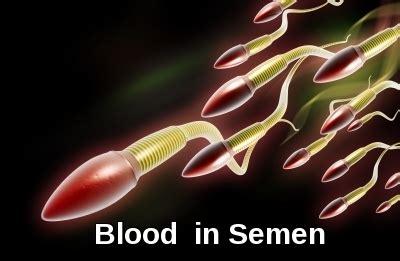 How Long After Prostate Biopsy Is There Blood In Semen
