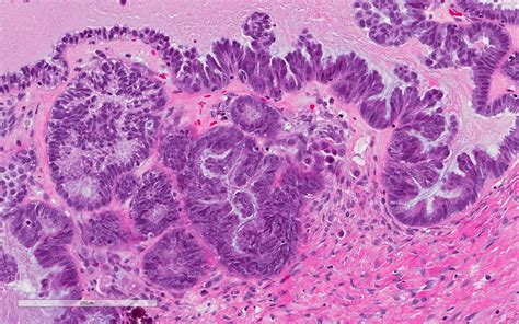 Pathology Outlines Serous Borderline Tumor