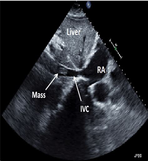 Full Text An Incidental Mass In The Inferior Vena Cava Discovered On