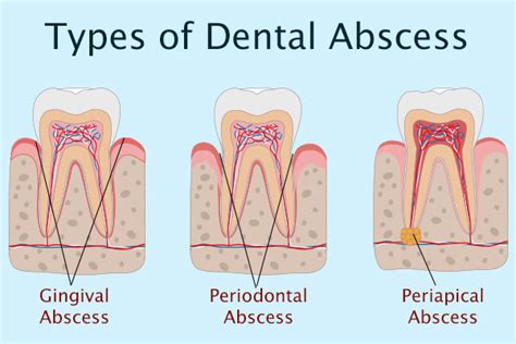 Tooth Abscess Causes And How Long Does It Take To Heal