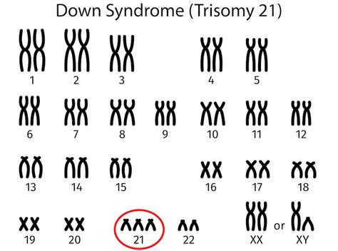 Are There Ways To Prevent Or Cure Down Syndrome The Tech Interactive