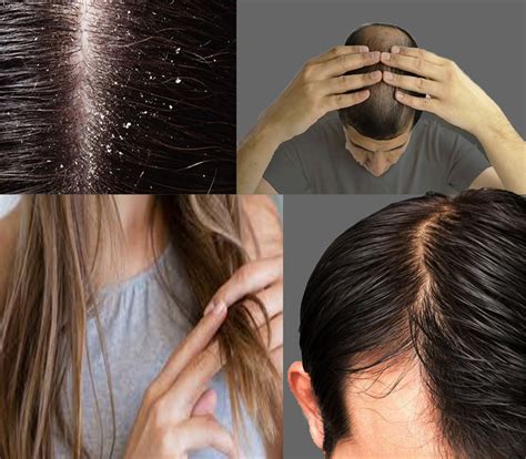 Types Of Hair Problems And How To Get Rid Of Hair Problems Hair Falled
