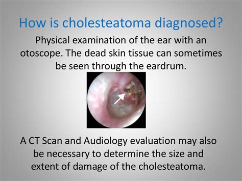 What Is Cholesteatoma