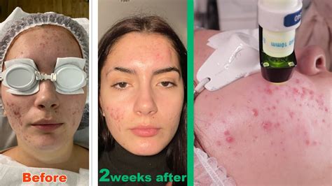 Clear Skin Laser Treatment For Acne 2022 Bespoke Acne Innovation Treatment That Actually Works