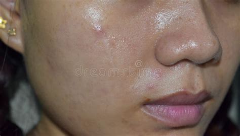 亚洲年轻女性脸上的粉刺黑斑和疤痕 库存图片 图片 包括有 面颊 女孩 地点 聚会所 囊状 毛孔 231226133