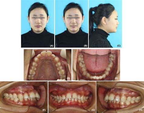 Orthodontic Treatment Of An Adult Class Ii Division 1 Malocclusion With
