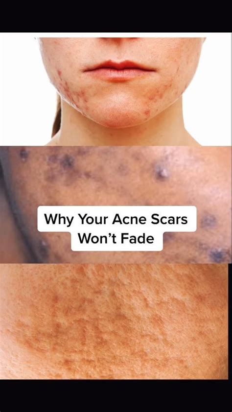 How To Fade Acne Scars Artofit