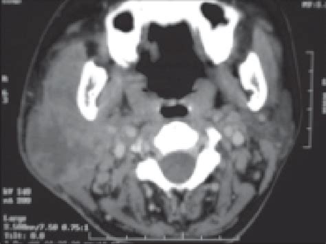 Ct Scan Showed Right Parotid Abscess With Early Extension To