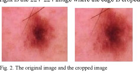 Figure 2 From Skin Lesion Classification Based On Deep Convolutional