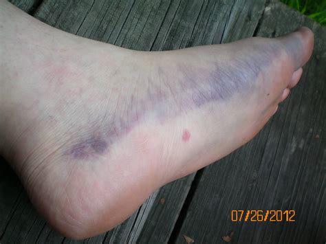 Broken Foot Bruise Swollen And Bruised Marion Carroll Flickr