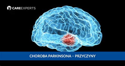 Choroba Parkinsona Przyczyny Care Experts