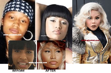 Nicki Minaj Before Plastic Surgery Plastic Surgery Before And After