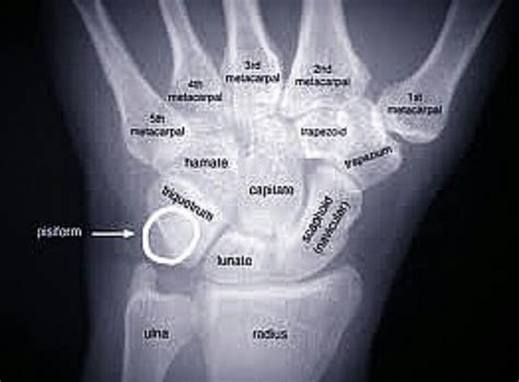 A Normal Wrist Xray Radiology Student Physical Therapist Assistant