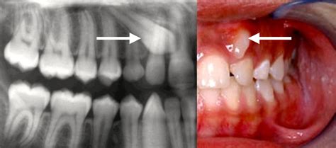 Impacted Canine 3md Pacific Oral Surgery