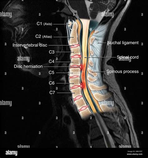 Cervical Spine Injury Mri Stock Photo Alamy