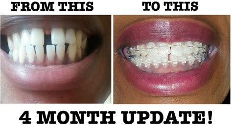 We hope this article helps you decide the best course of action for braces and aligners aren't the only ways to fill gaps in teeth. #8 My Braces Journey - 4 Month Braces Update | Why are ...