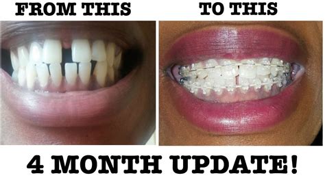 How long does it take to close gaps between teeth after an extraction? #8 My Braces Journey - 4 Month Braces Update | Why are ...