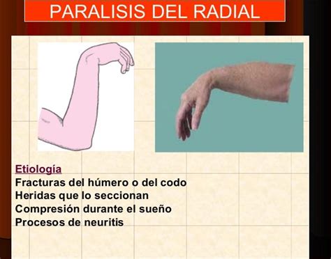 Lesiones De Nervios Perifericos